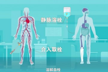 溶栓治疗有风险吗一般多少钱？溶栓对身体伤害有多大？血栓是怎么形成的