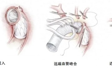 京健元一体化人工大血管，完成首例入组